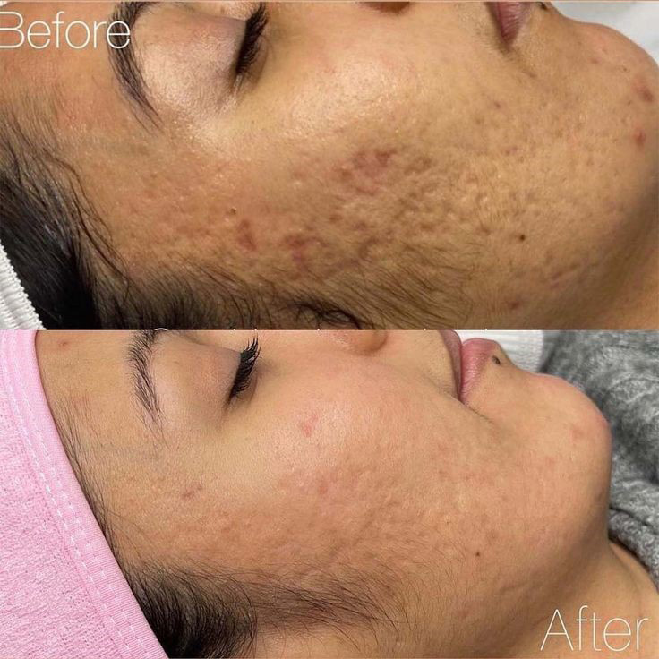 Acne Scar and Strechmark Treatment